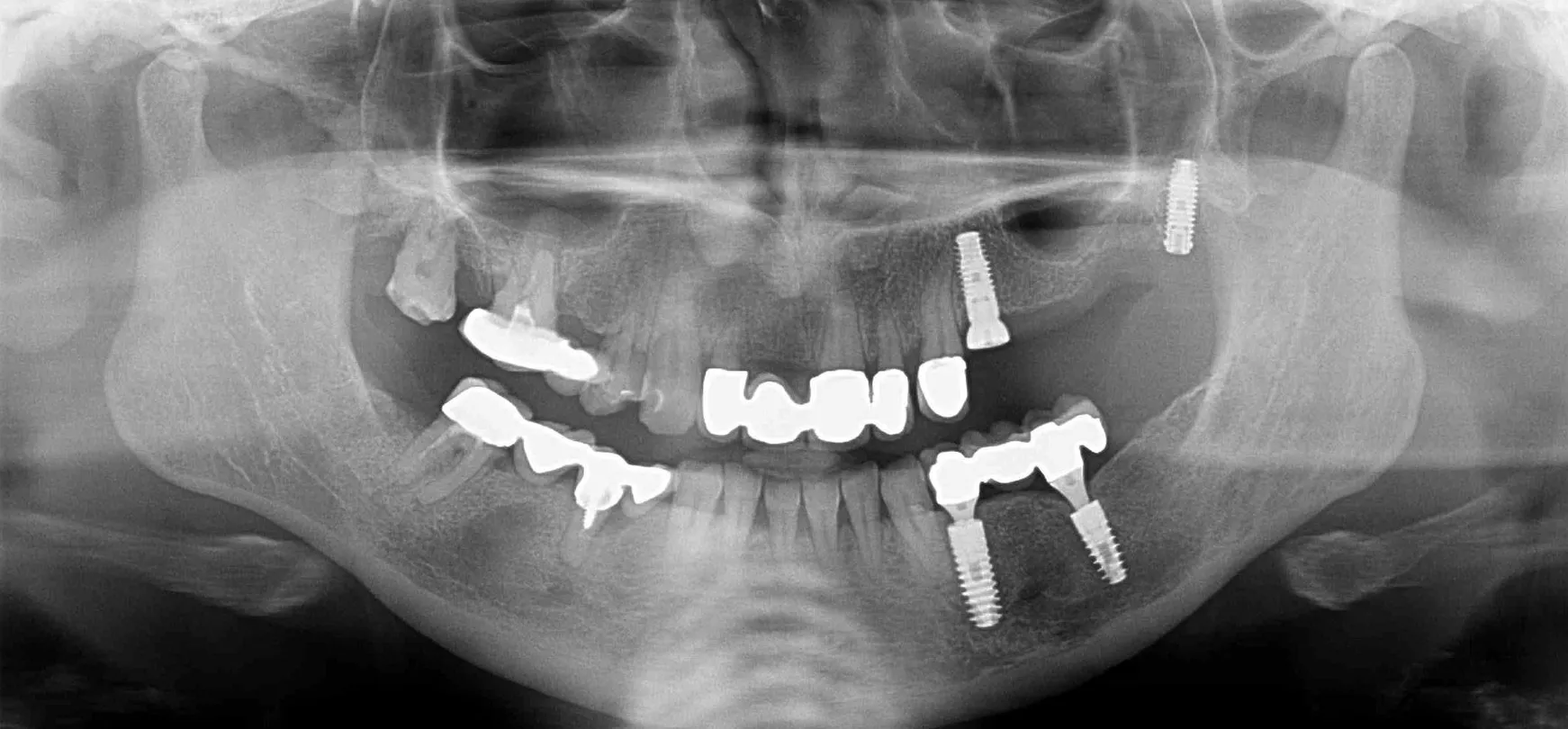 Röntgenbild aus der Praxis: Kiefer mit gesetzten Implantaten